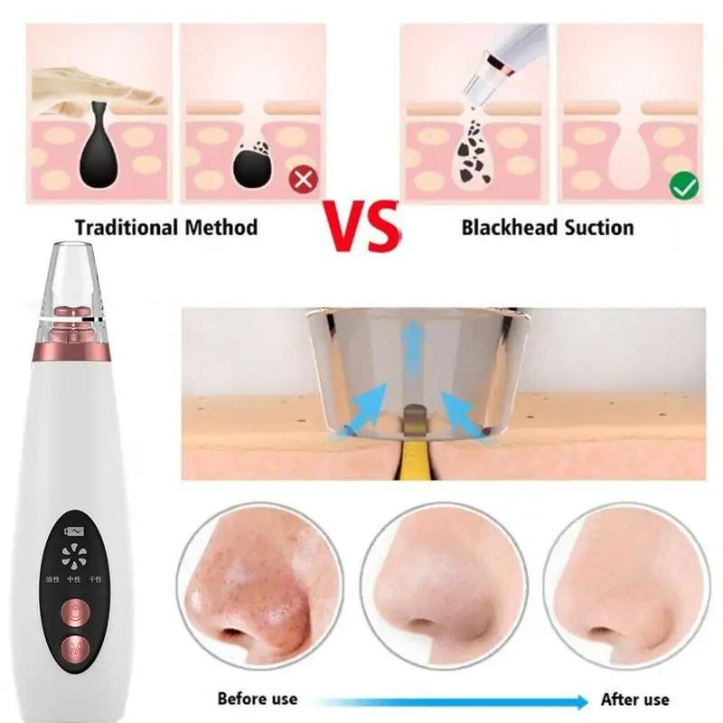 Rechargeable Blackhead Remover